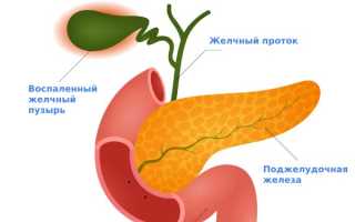 Холецистит