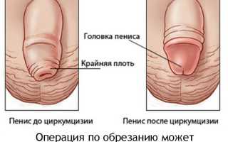 В каком возрасте можно и лучше всего делать обрезание?