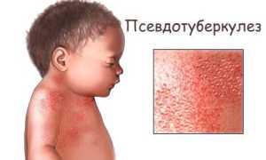 Псевдотуберкулез